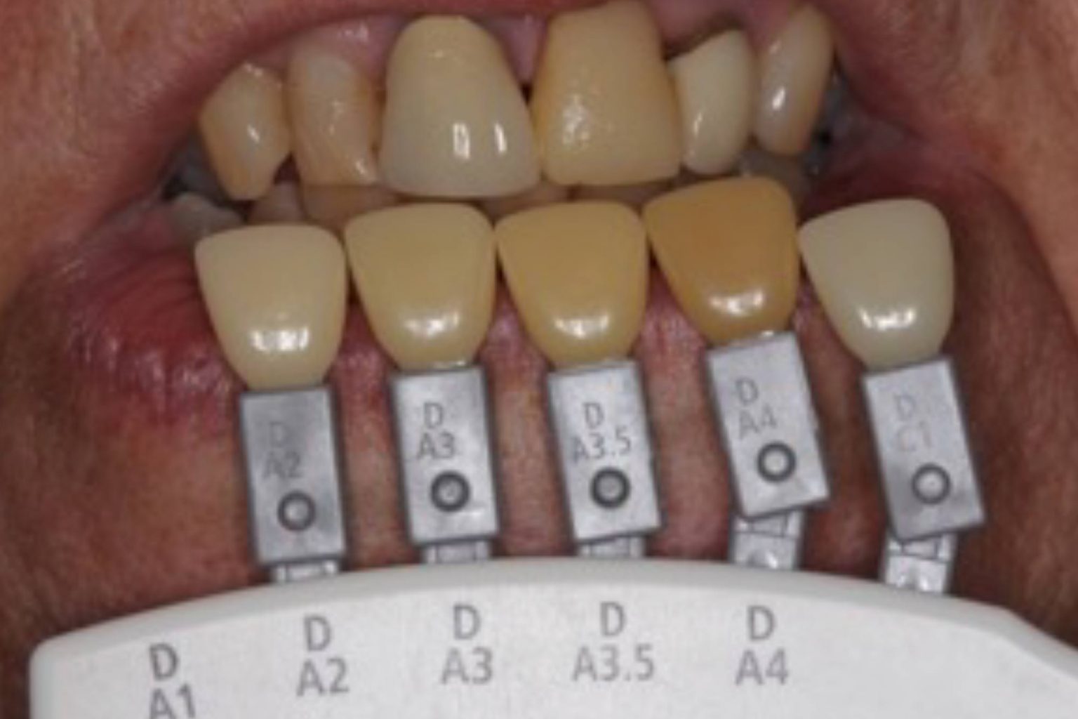 Tips for shade matching indirect restorations Dentistry