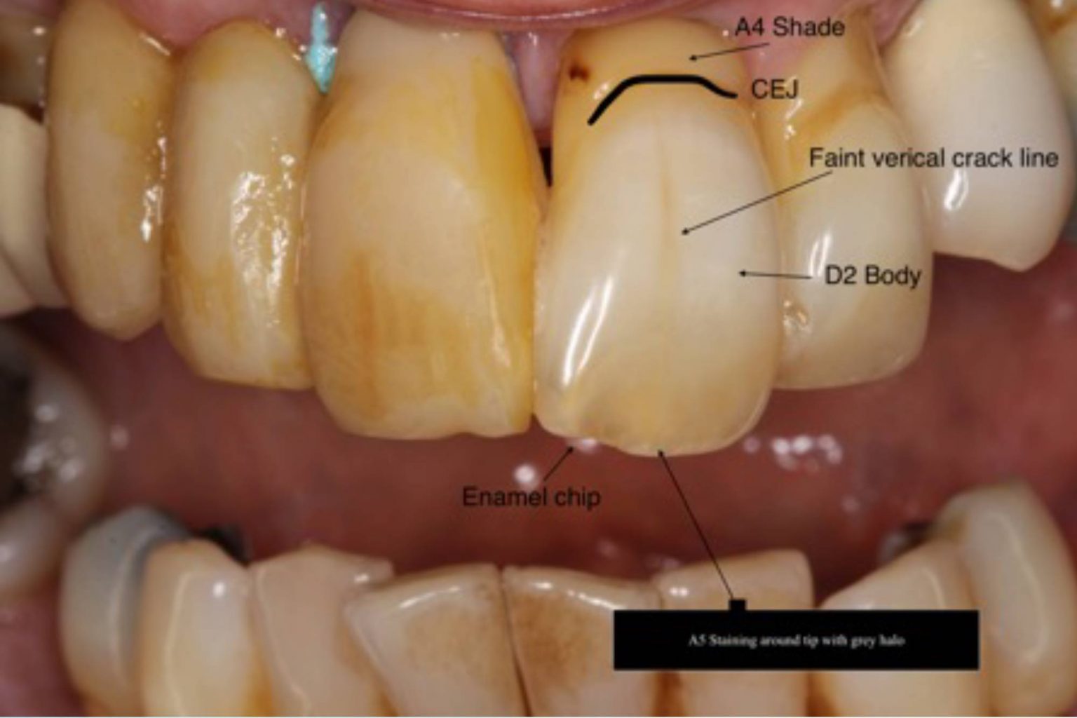 Tips for shade matching indirect restorations Dentistry