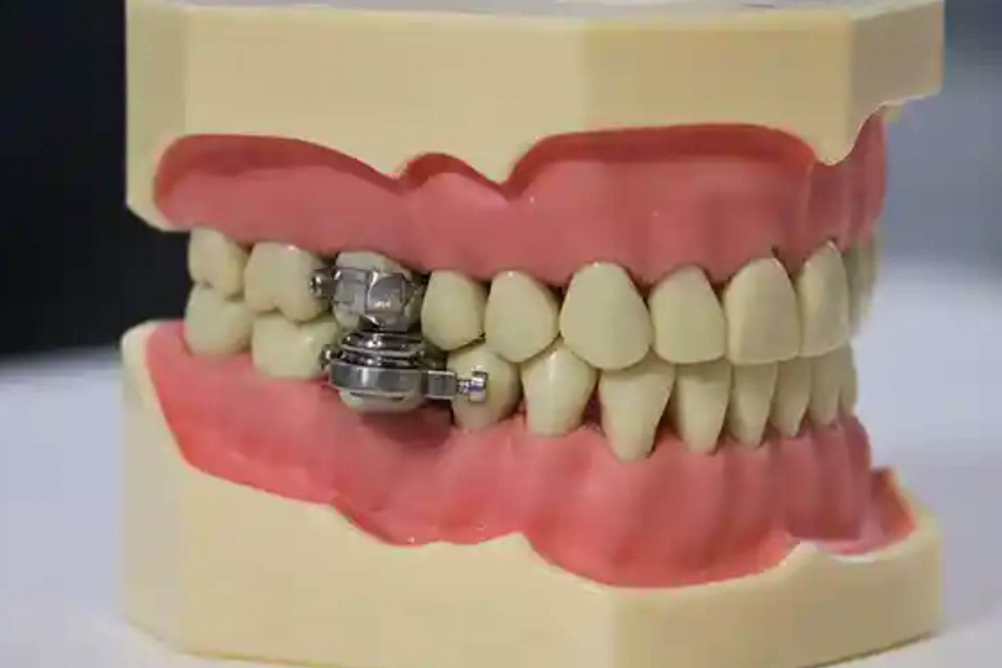 Weight loss dental device that prevents mouth opening designed to tackle obesity