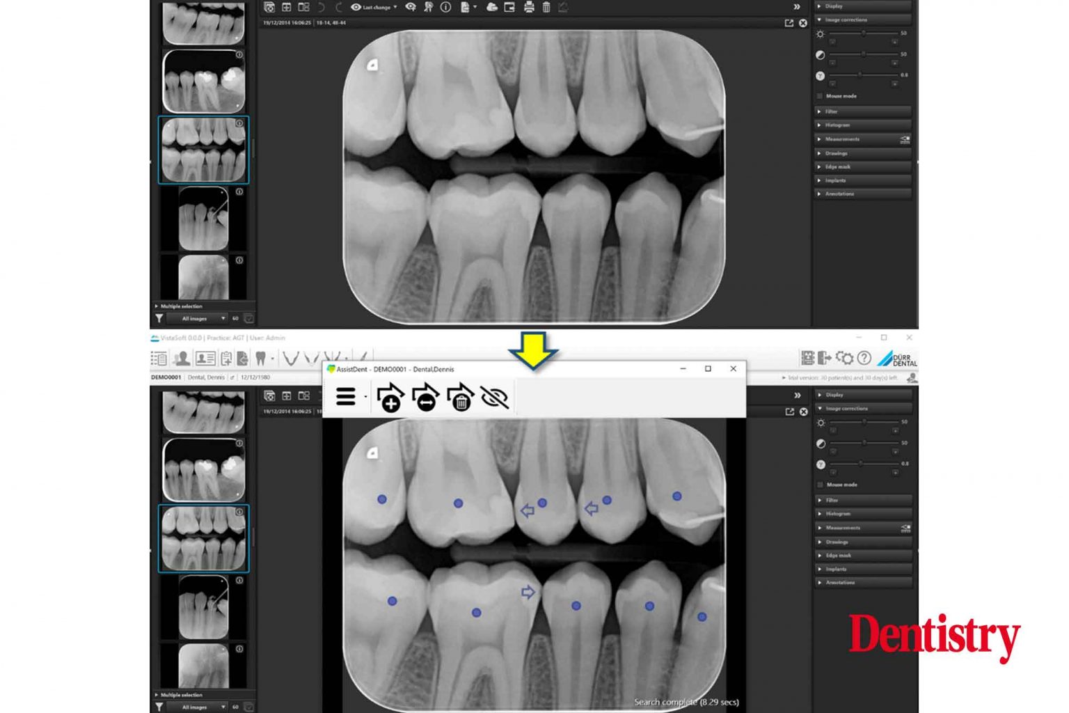 Using artificial intelligence to help with preventive dentistry Dentistry