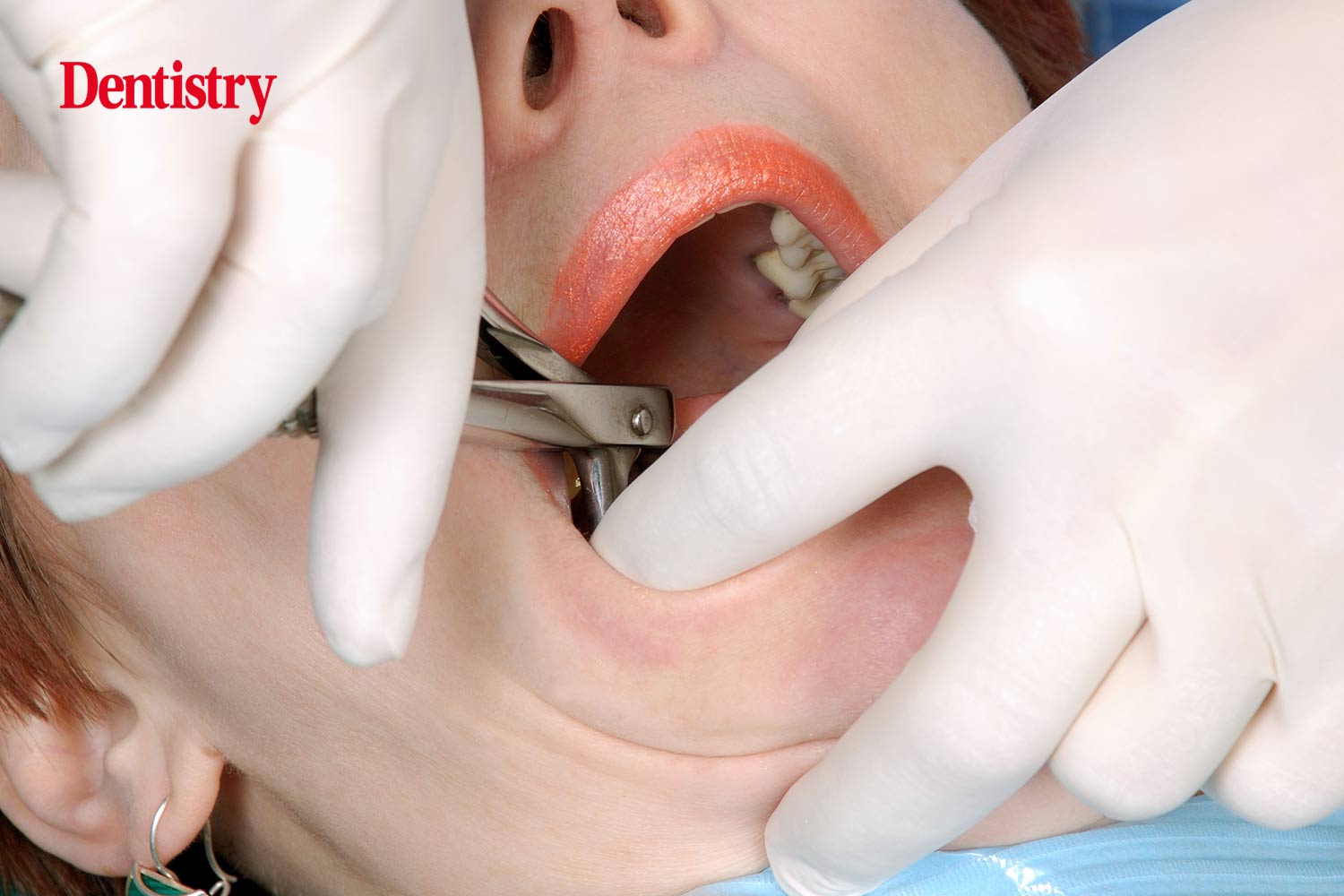 Women breaks into dental practice and extracts 13 teeth from patient