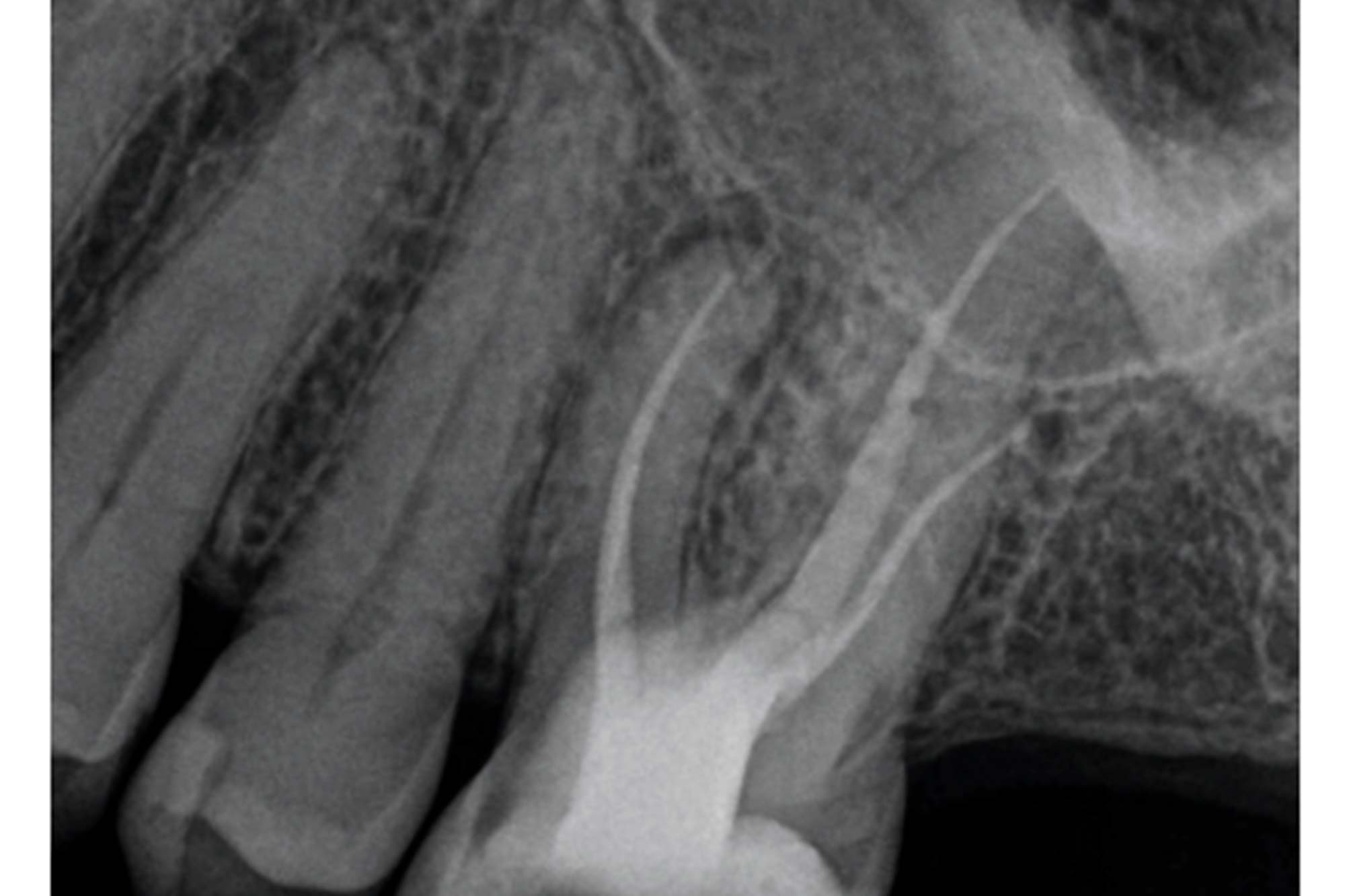 crown-lengthening-5 - Dentistry.co.uk