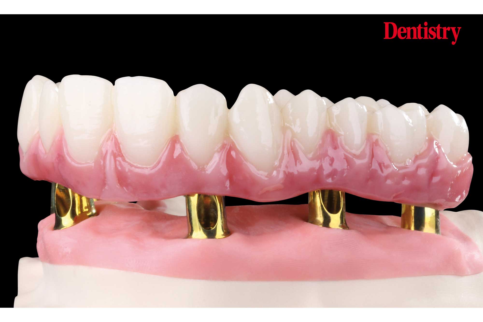 abutment teeth