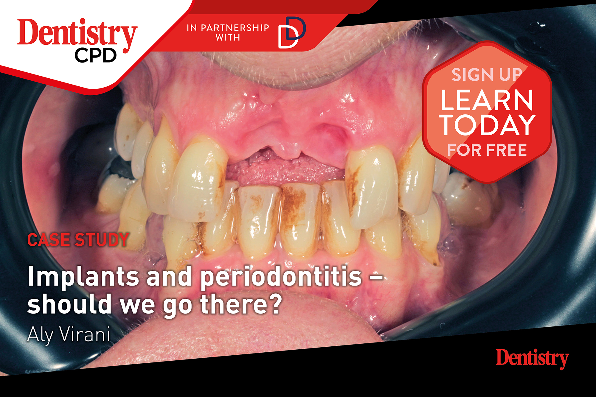 implants and periodontitis – should we go there?