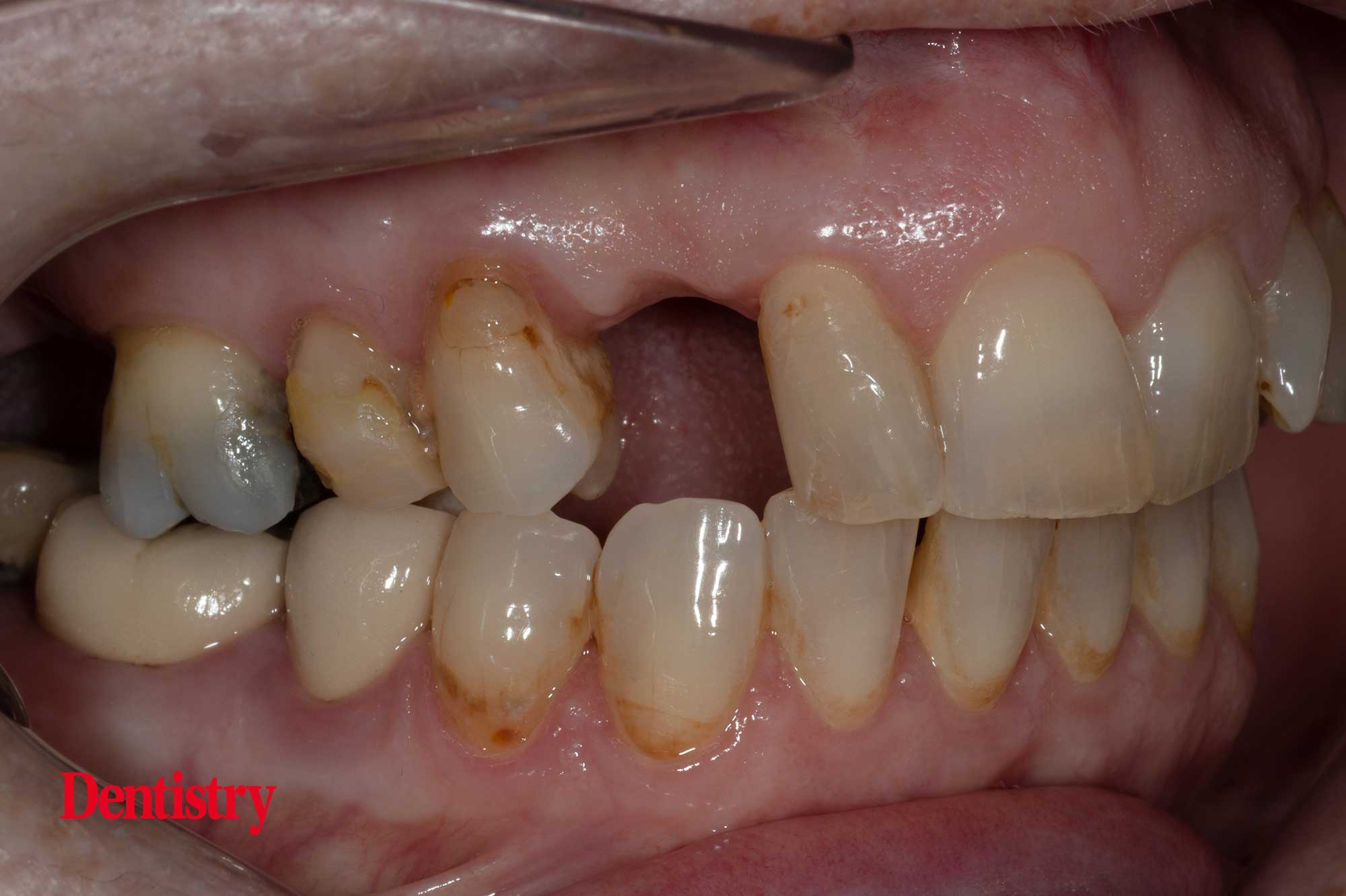 Prosthodontips resinretained bridges fun and predictable Dentistry