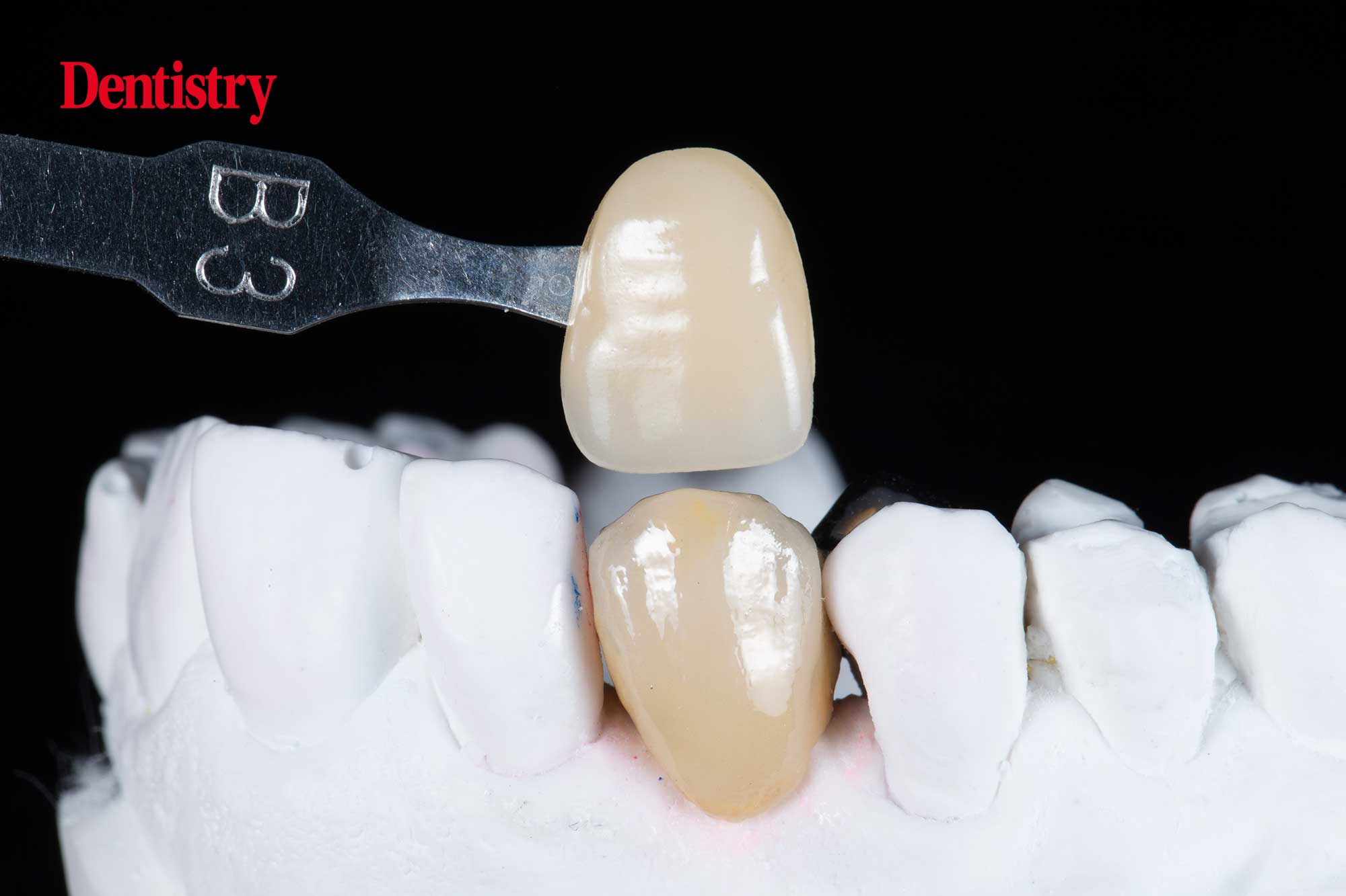 Prosthodontips resinretained bridges fun and predictable Dentistry