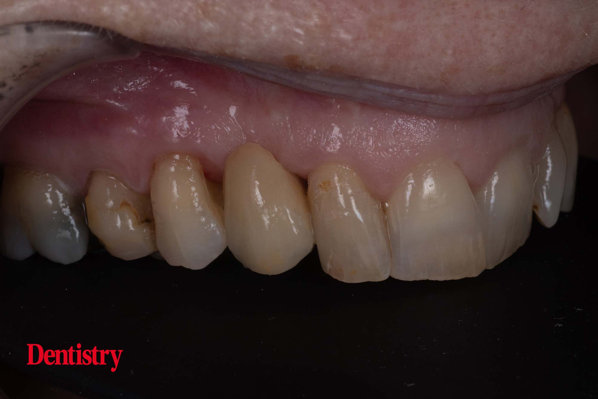 Prosthodontips resinretained bridges fun and predictable Dentistry
