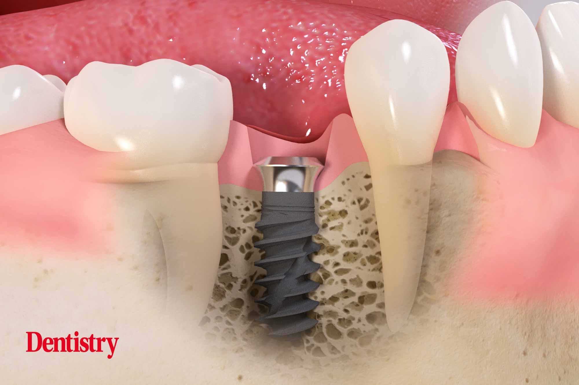 Straumann TLX implant