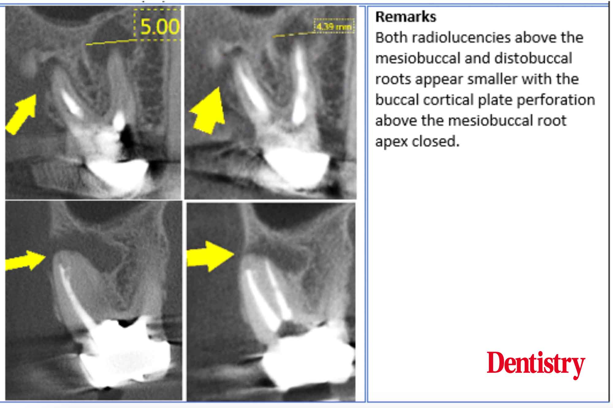 Ultra-low dose endodontic x-Ray