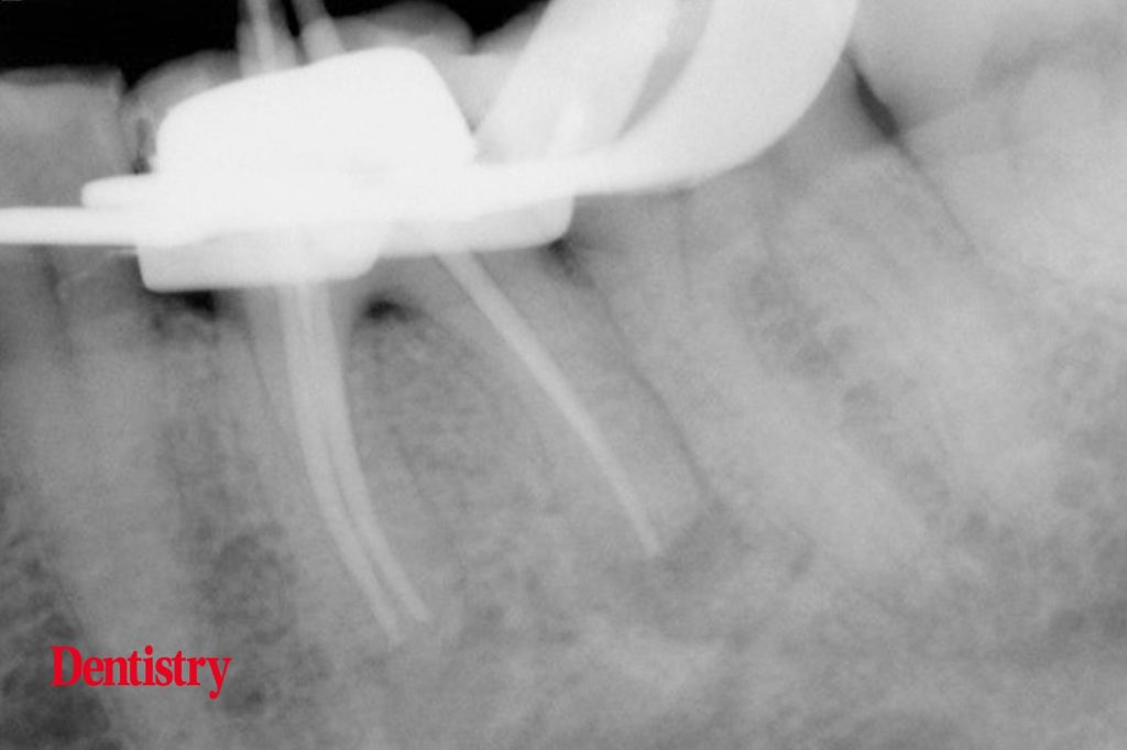 Exploring Endodontics a silver point of order Dentistry