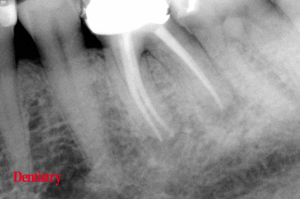 Exploring Endodontics a silver point of order Dentistry