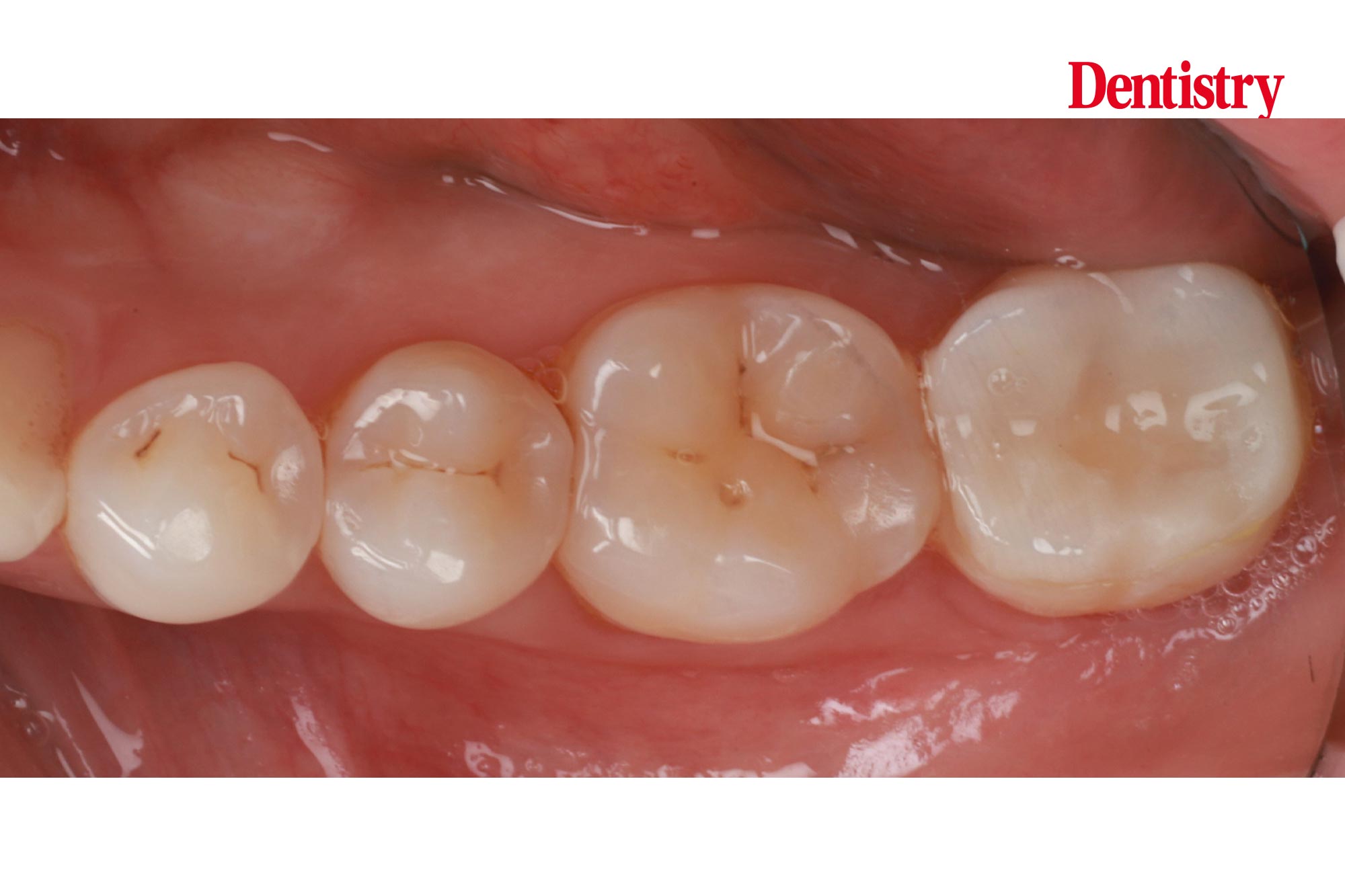 Prosthodontips – restoration of a lower second molar - Dentistry