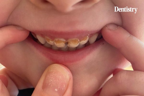 poor oral health in children