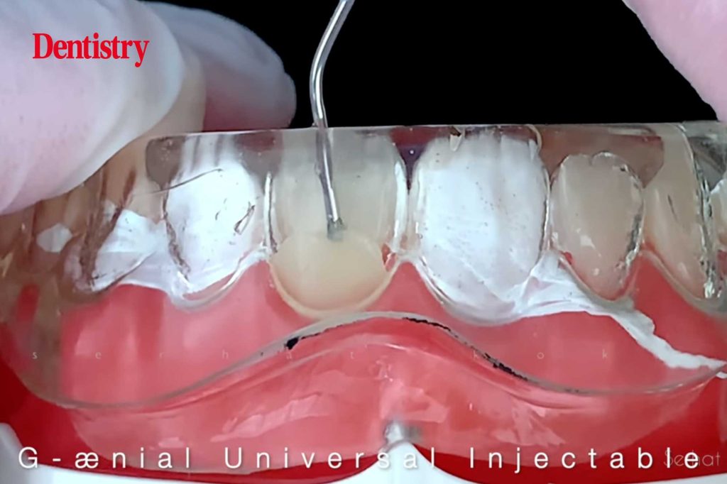 Injection moulding technique with G-ænial Universal Injectable - Dentistry