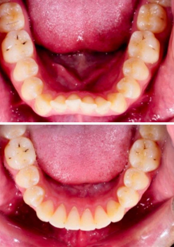 Practice growth with Active Aligners Dentistry