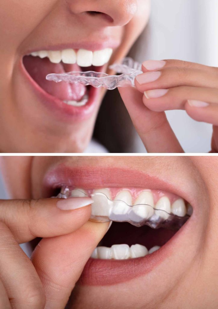 Practice growth with Active Aligners Dentistry