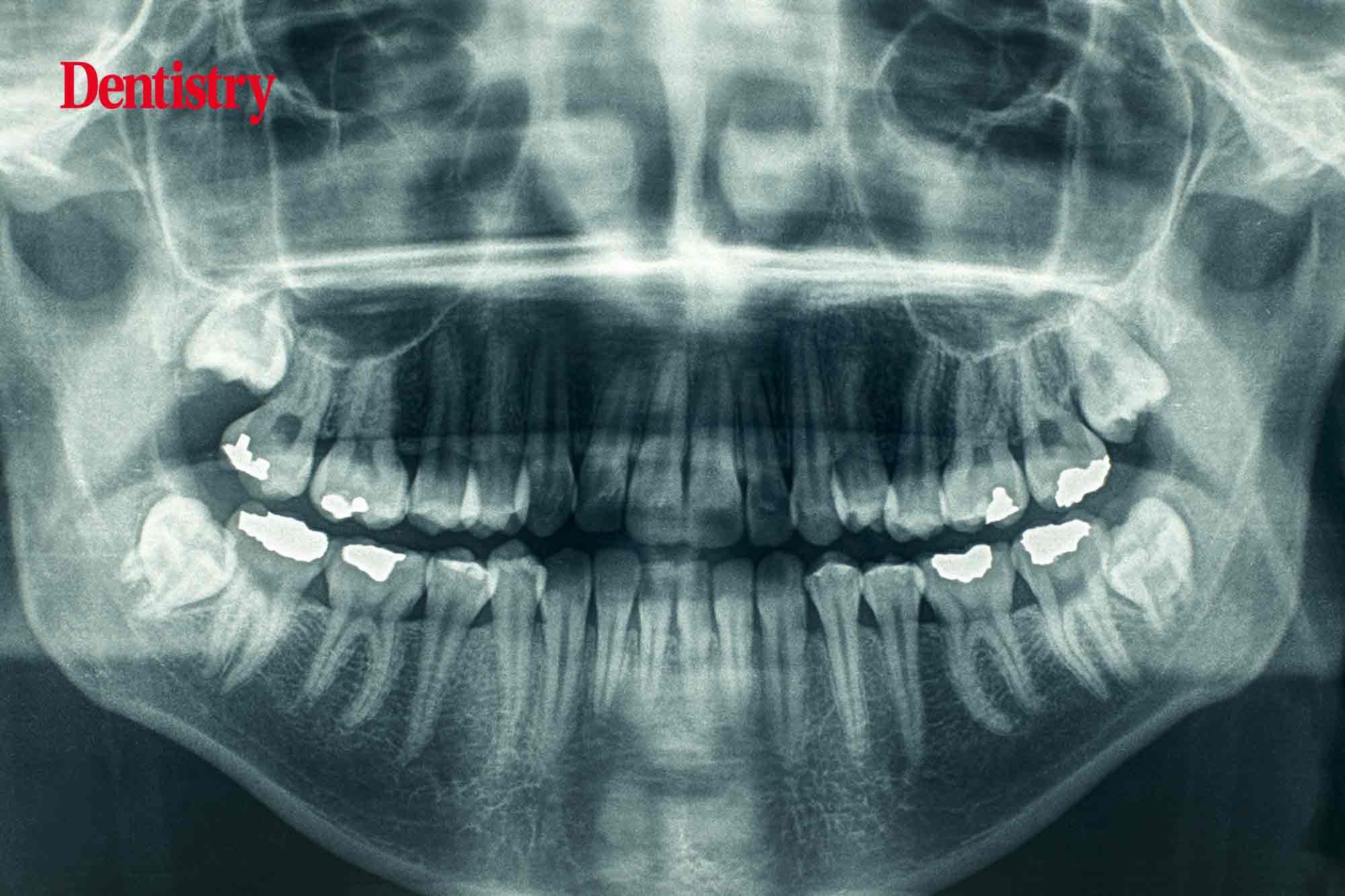 Lords argue against use of dental x rays on asylum seekers