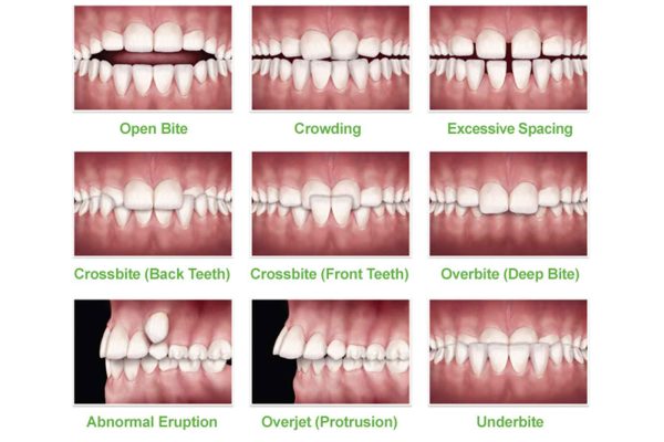 Introduction to early interceptive orthodontics and orthopaedics