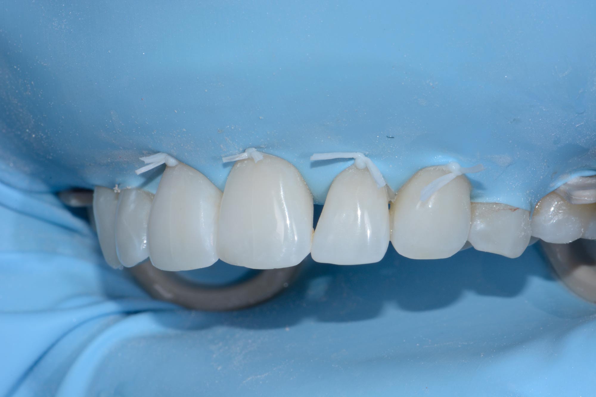Composite restorations closing and open gingival embrasure Dentistry