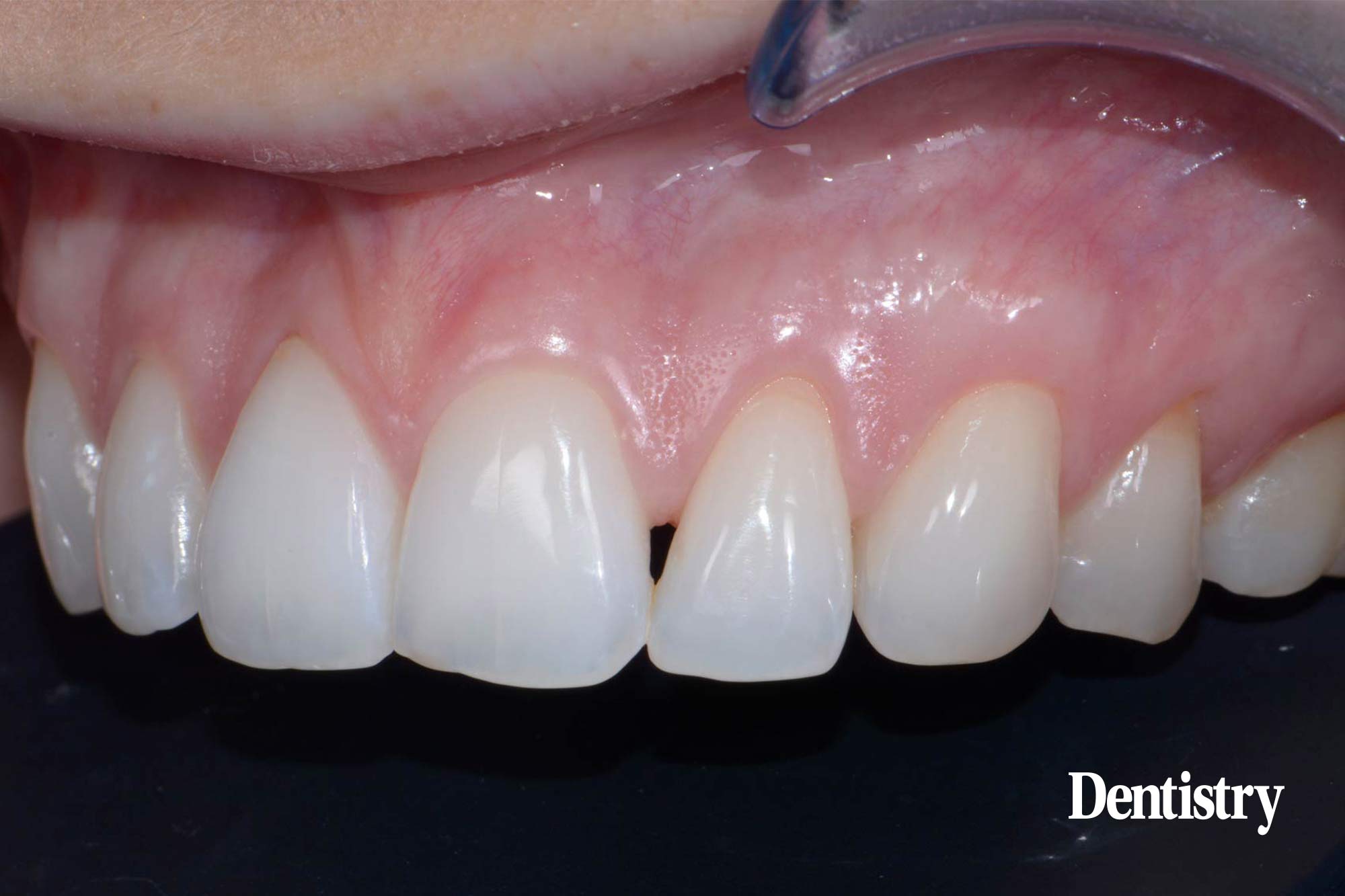 Composite restorations: closing and open gingival embrasure