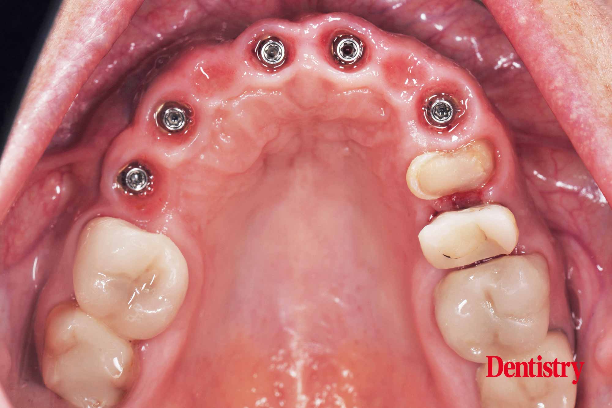 Digital workflow: a game changer for implant restoration