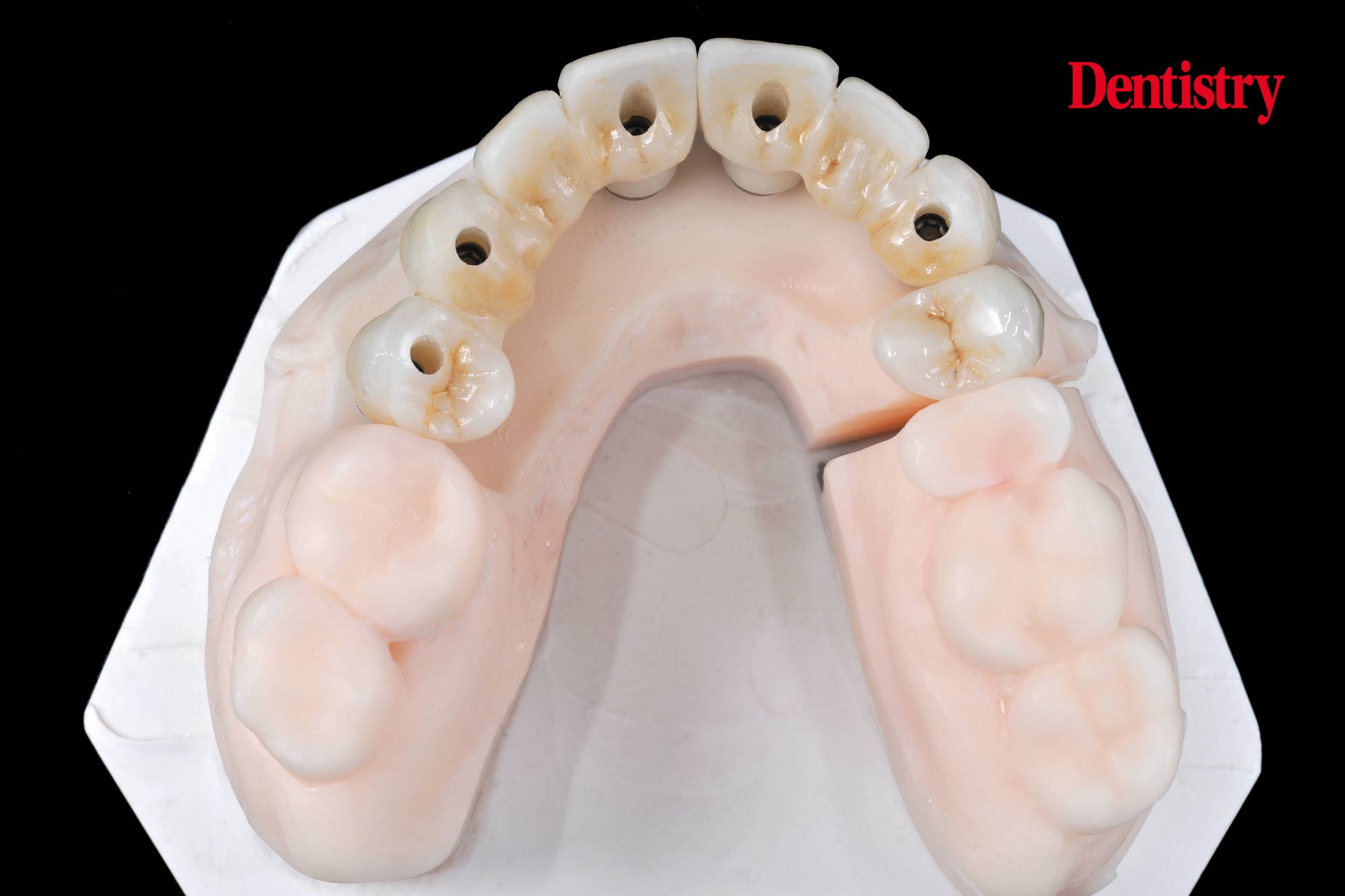 Digital workflow: a game changer for implant restoration – part two