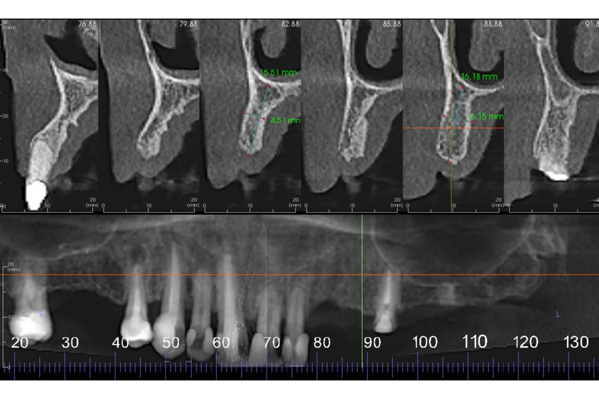 mucosal-lining-thickening-of-the-left-sphenoid-sinus-dentistry