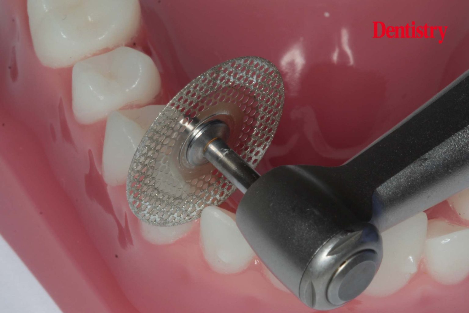 Total Orthodontics IPR is nothing to fear Dentistry