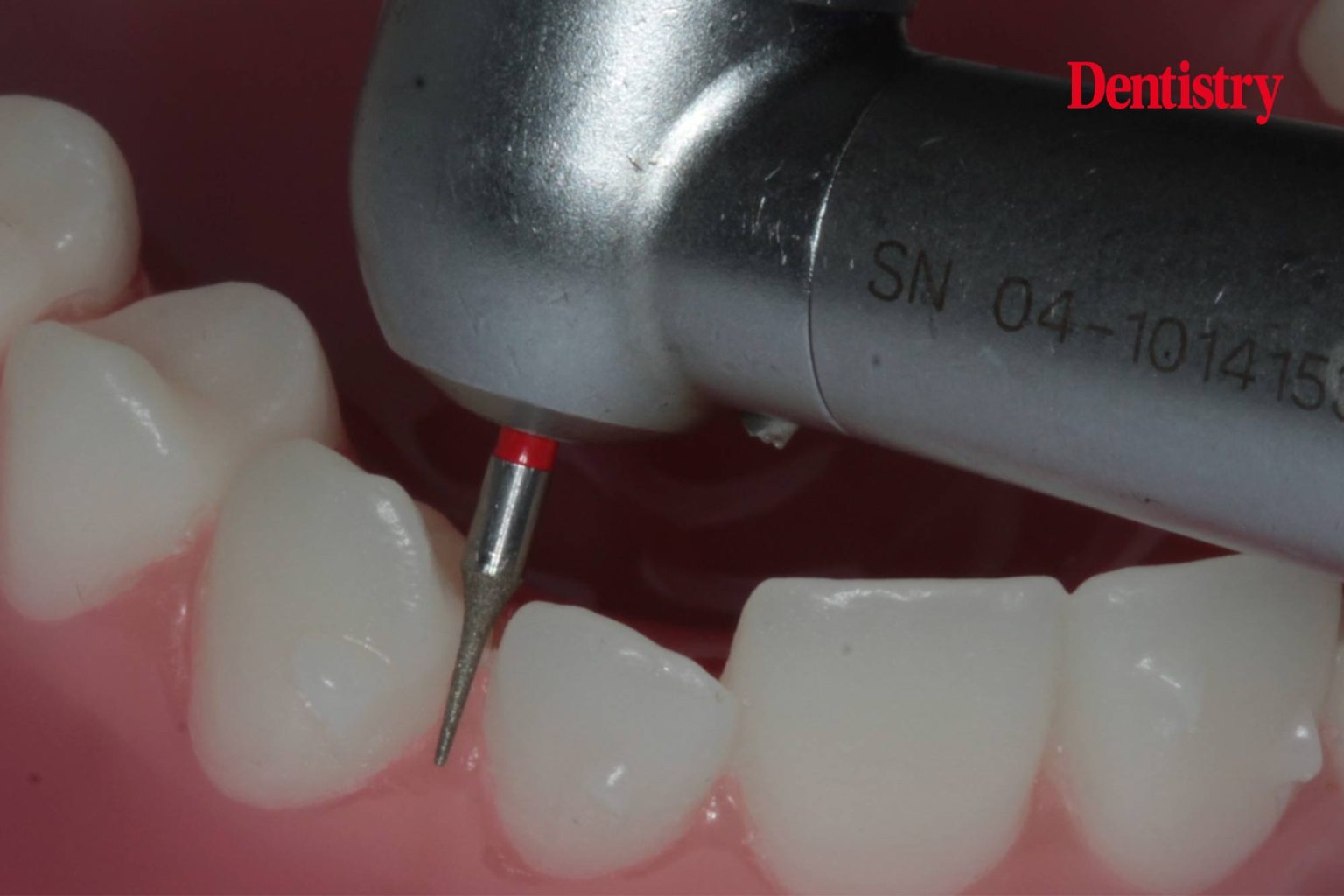 Total Orthodontics IPR is nothing to fear Dentistry