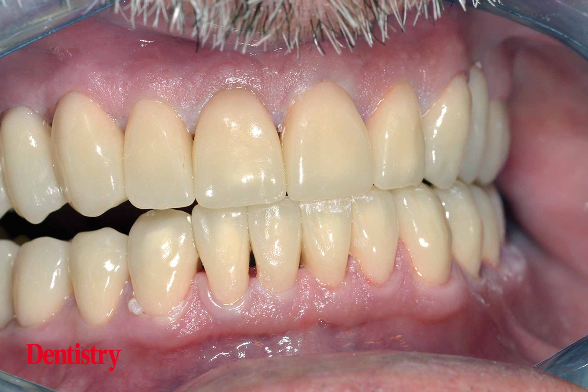 Cementation of crowns without chipping part one Dentistry