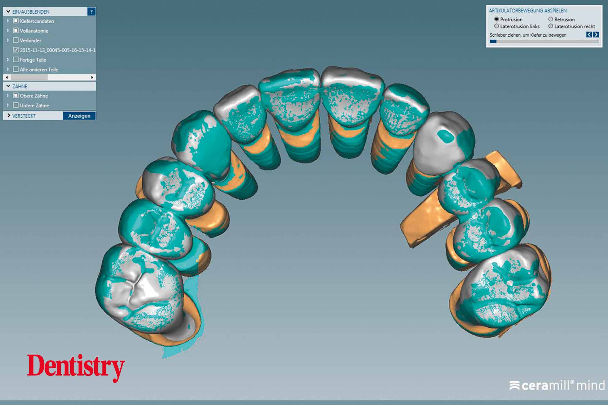 Cementation of crowns without chipping part two Dentistry