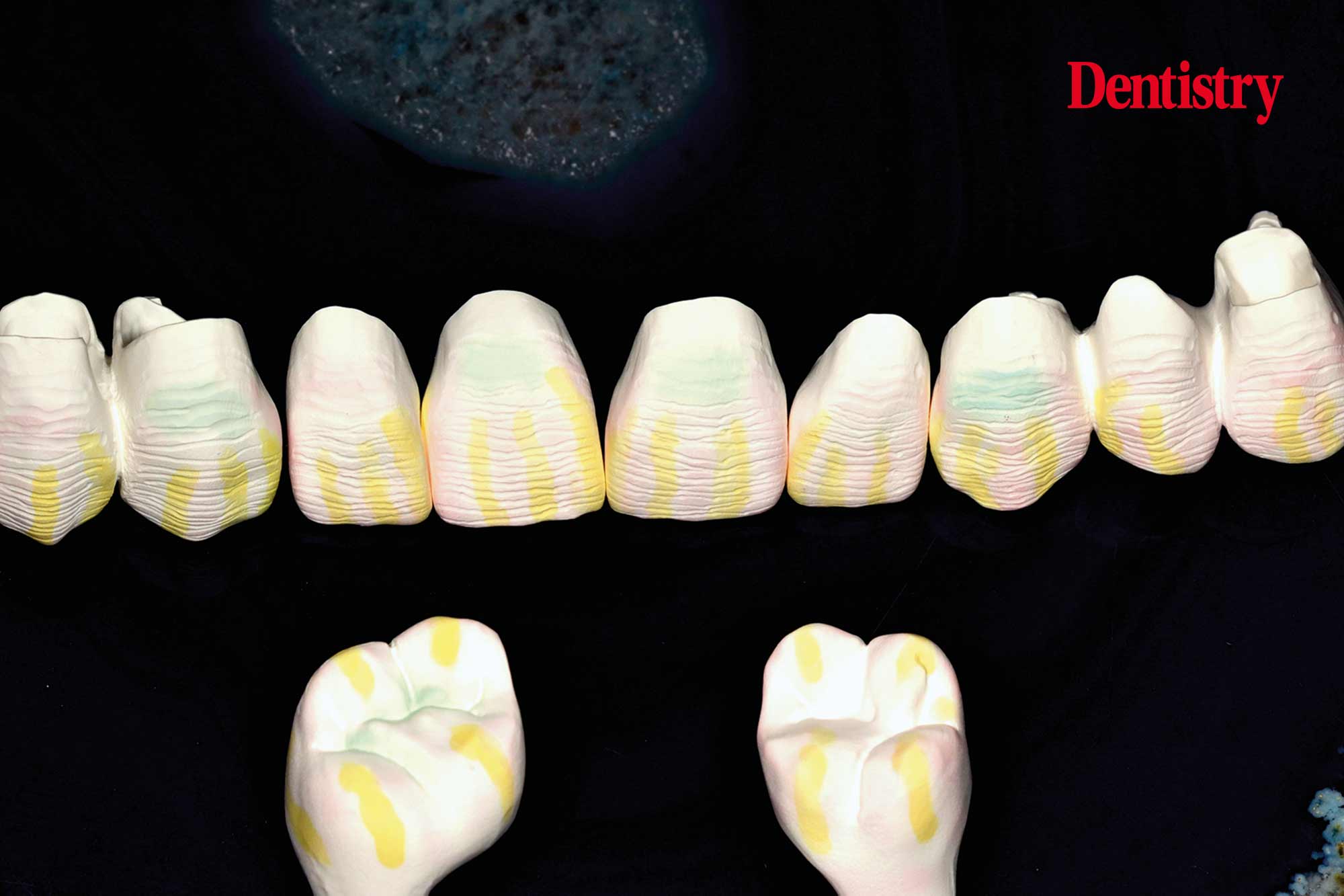Cementation of crowns without chipping part two Dentistry