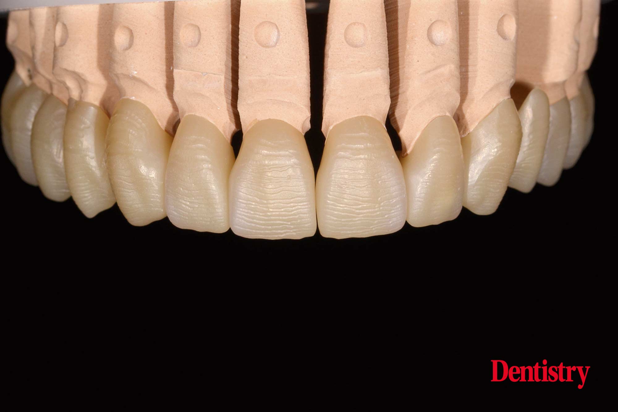Cementation of crowns without chipping part two Dentistry
