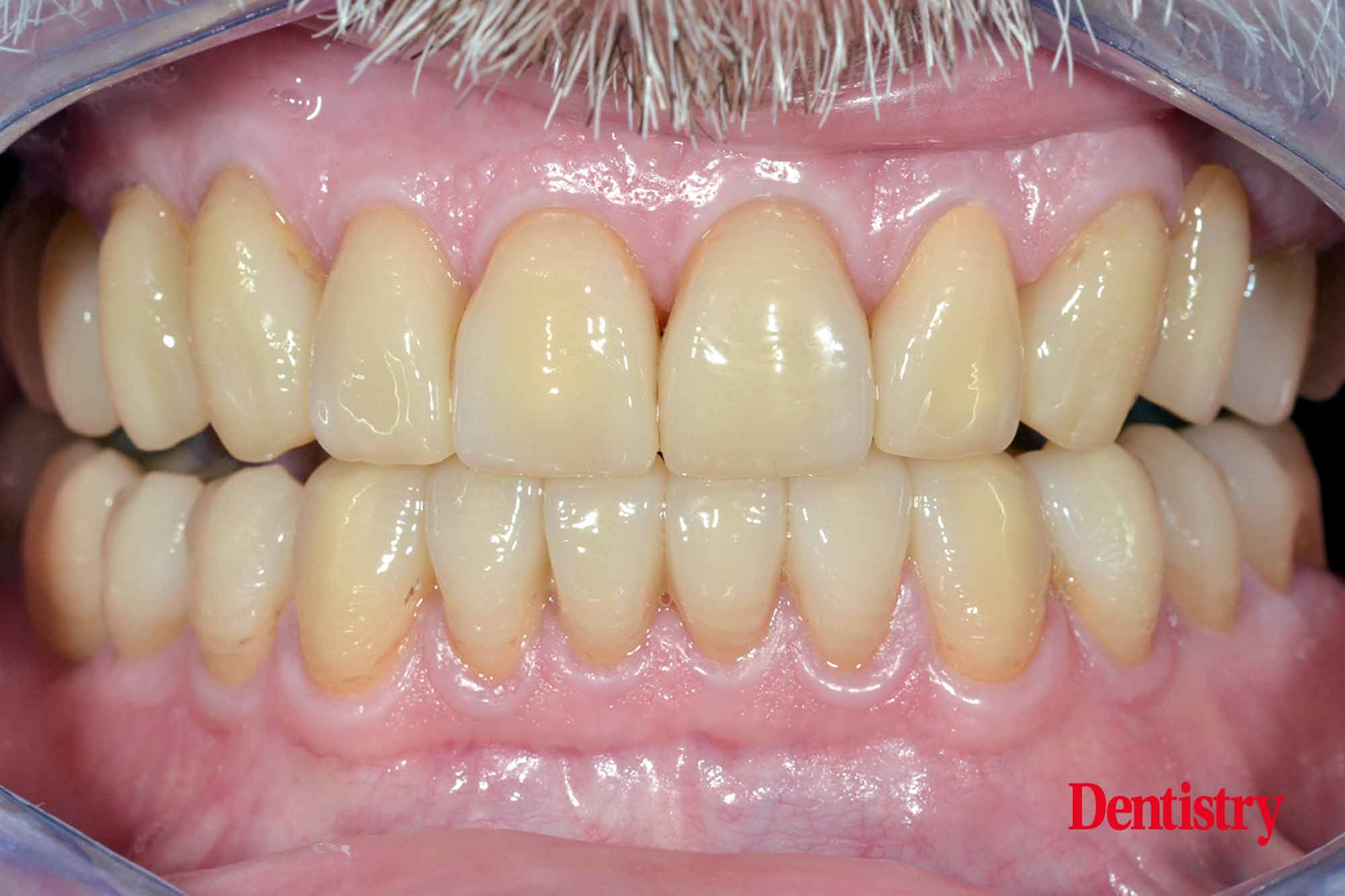 Fabrication and cementation of crowns without chipping