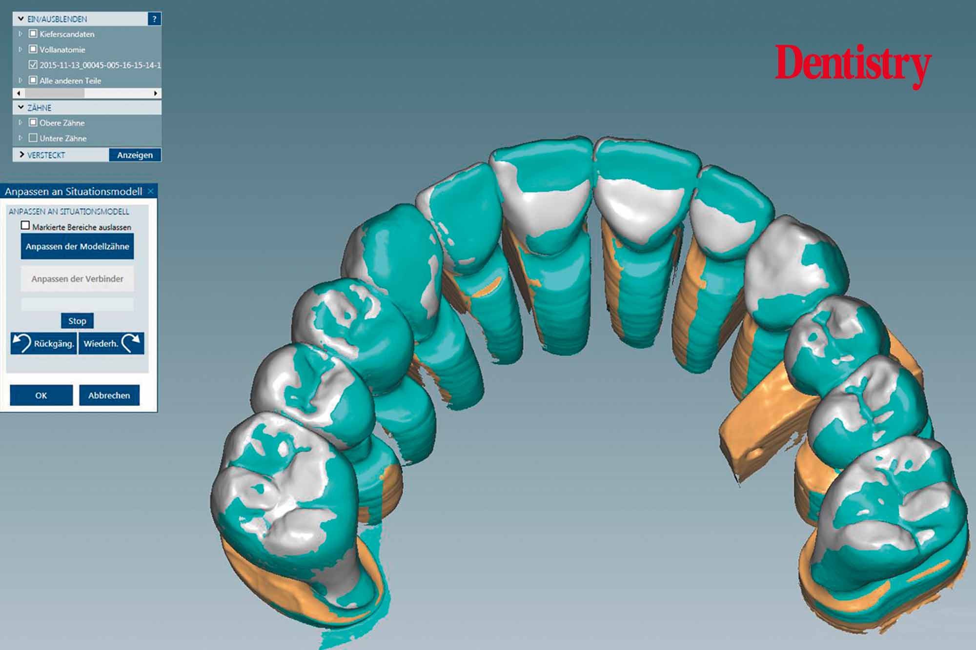 Cementation of crowns without chipping part two Dentistry