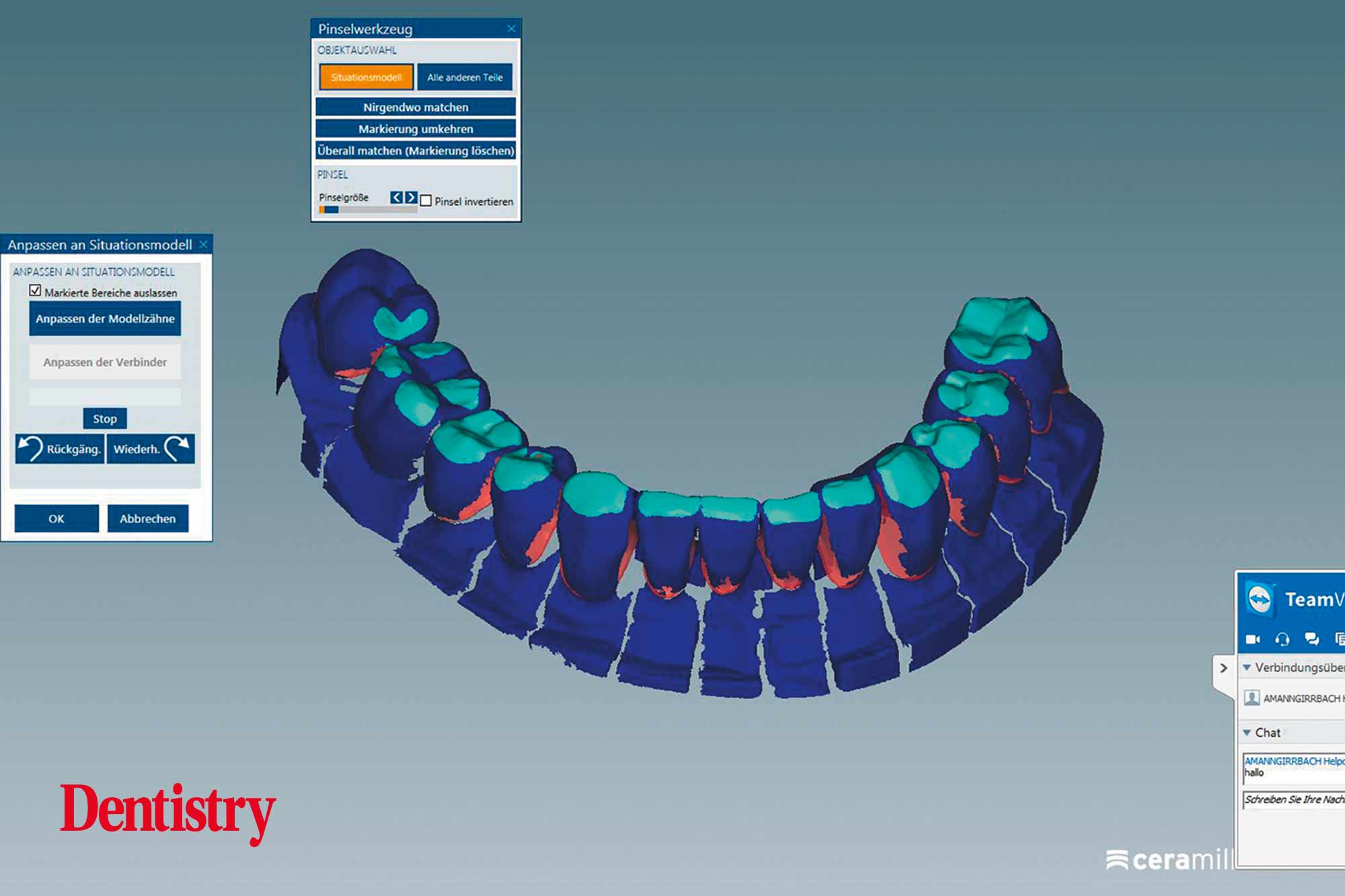 Cementation of crowns without chipping part two Dentistry