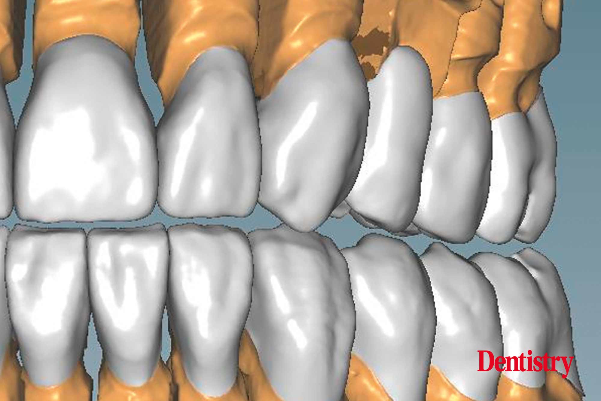Cementation of crowns without chipping part two Dentistry