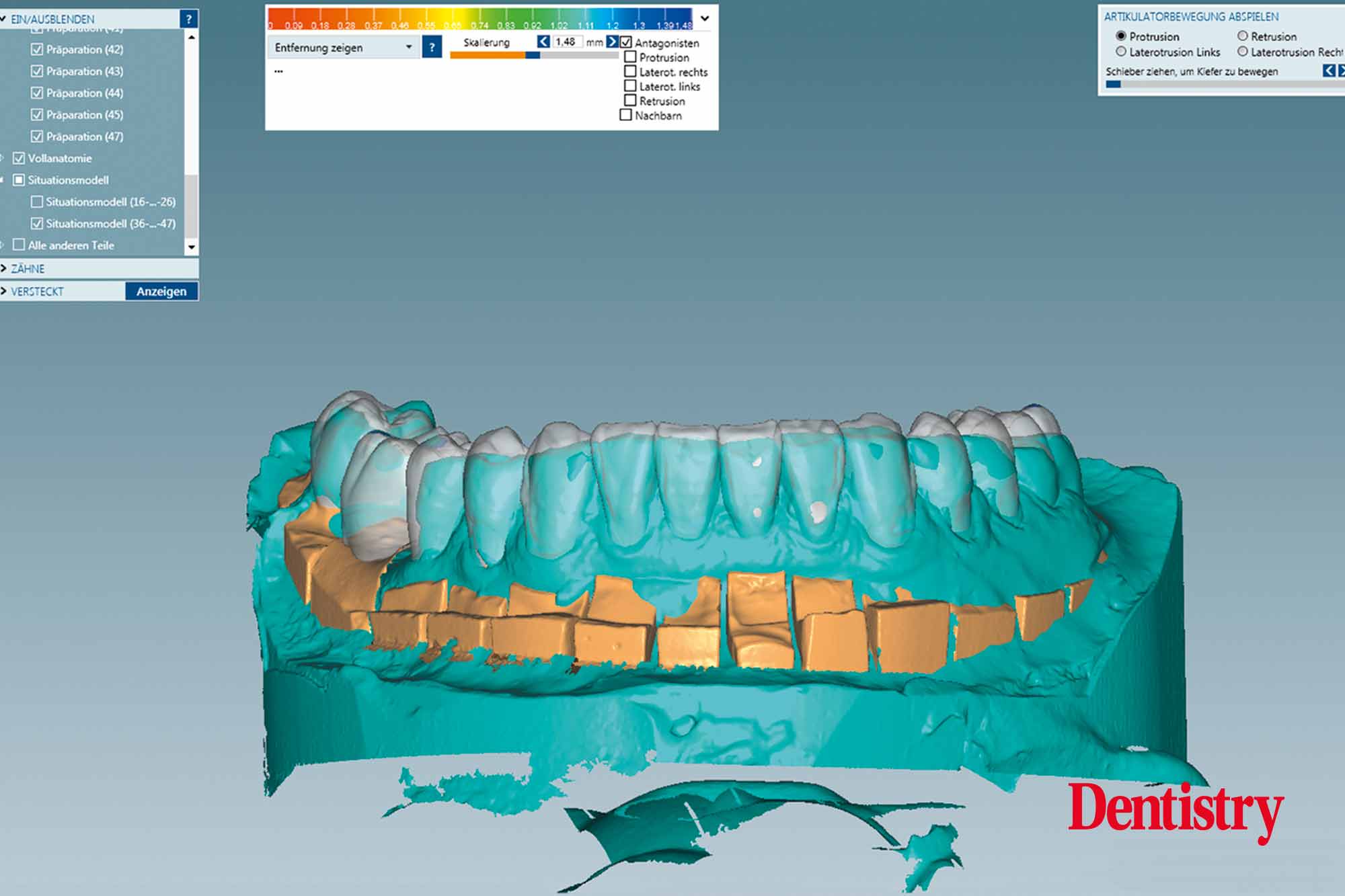 Fabrication and cementation of crowns without chipping