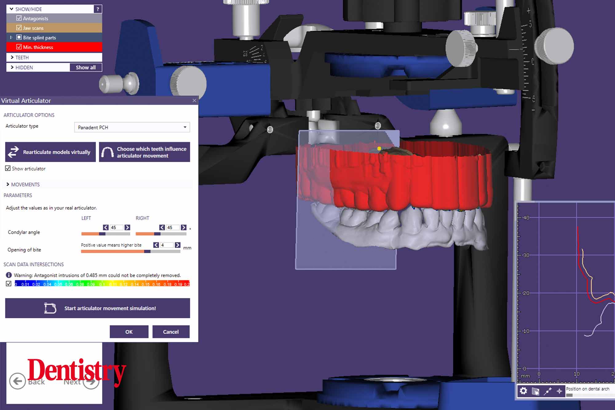 Andre Gaul RDT gives a step-by-step overview of the design and fabrication process of printed occlusal splints.