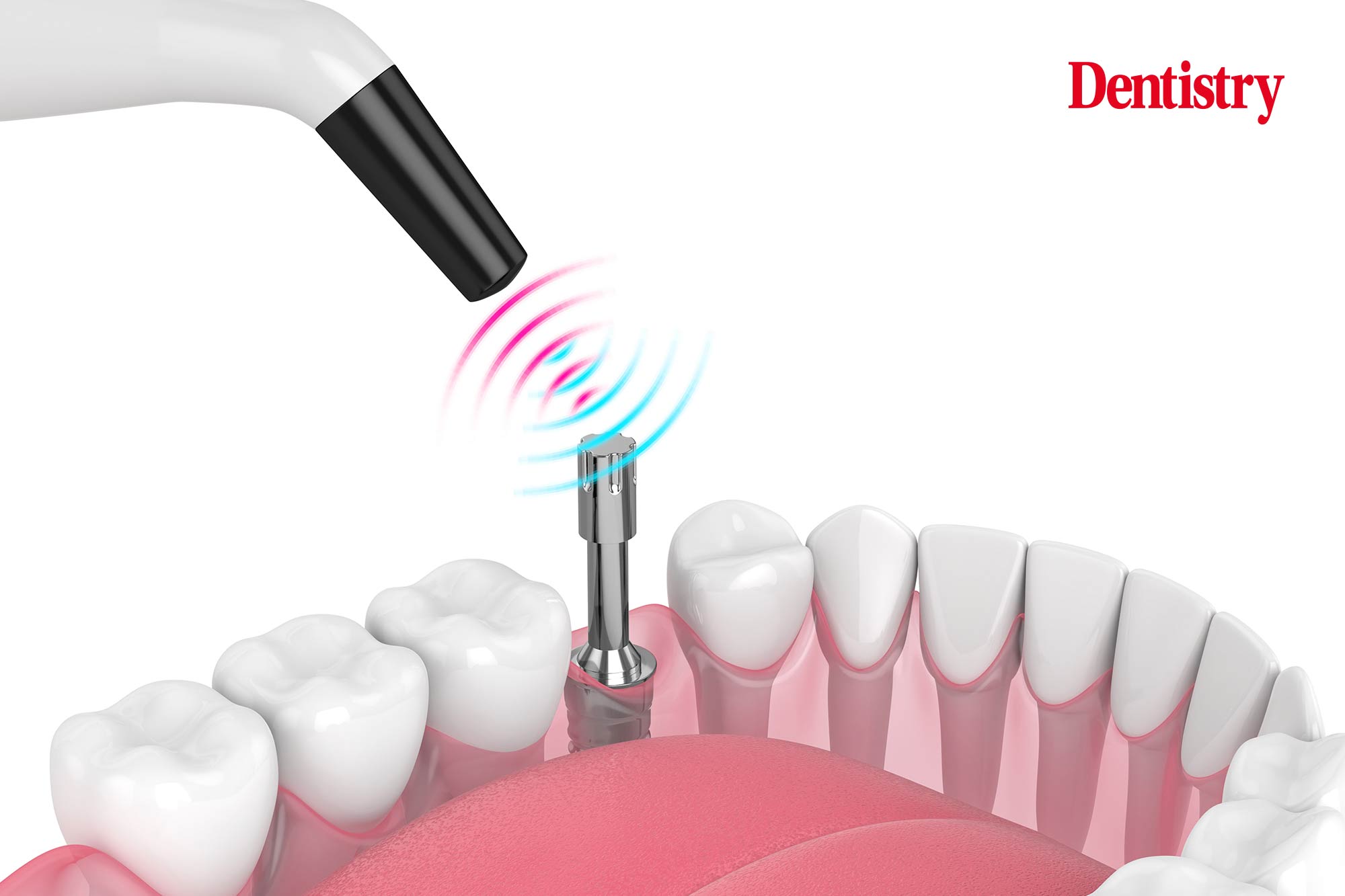 In this month's Implant Insights column, Morven McCauley assesses the use of ISQ devices, including their accuracy, cost and benefits.