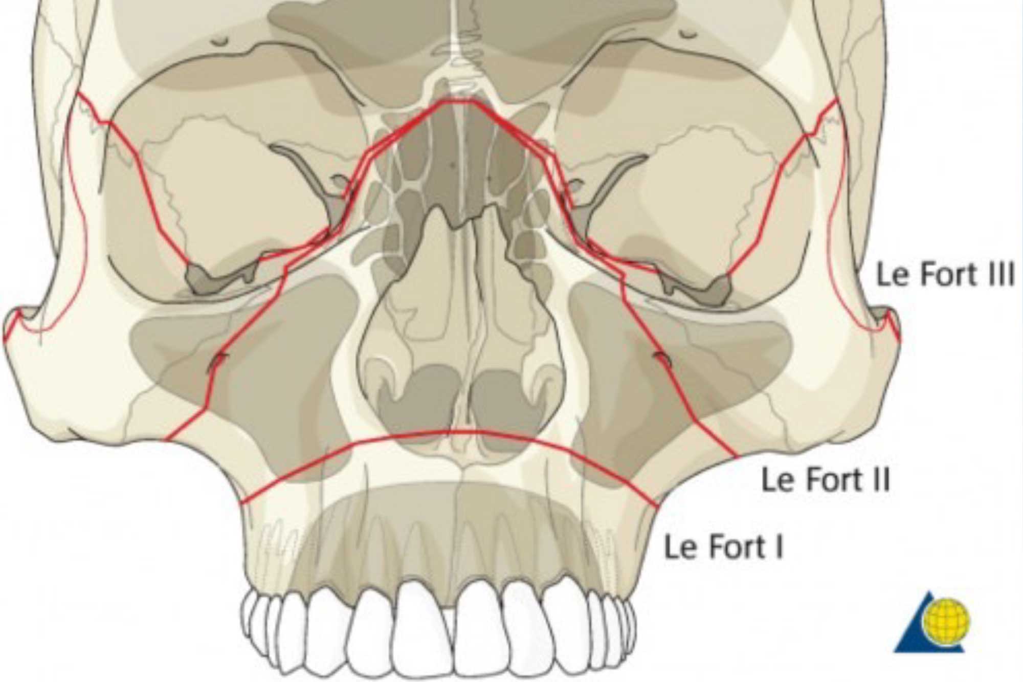 This month, Hannah Hook explores Le Fort fractures, including classifying each one and the best treatment option for the patient.