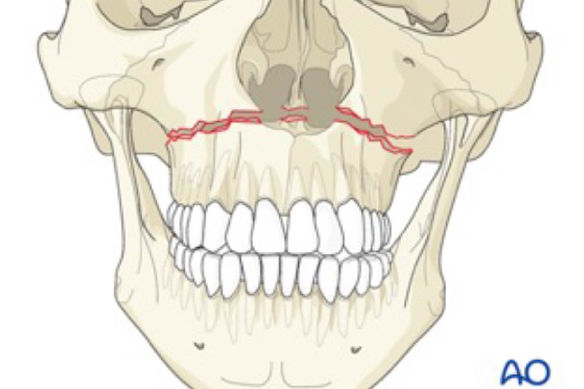 This month, Hannah Hook explores Le Fort fractures, including classifying each one and the best treatment option for the patient.