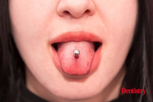 Tongue and lip piercings may damage teeth and gums