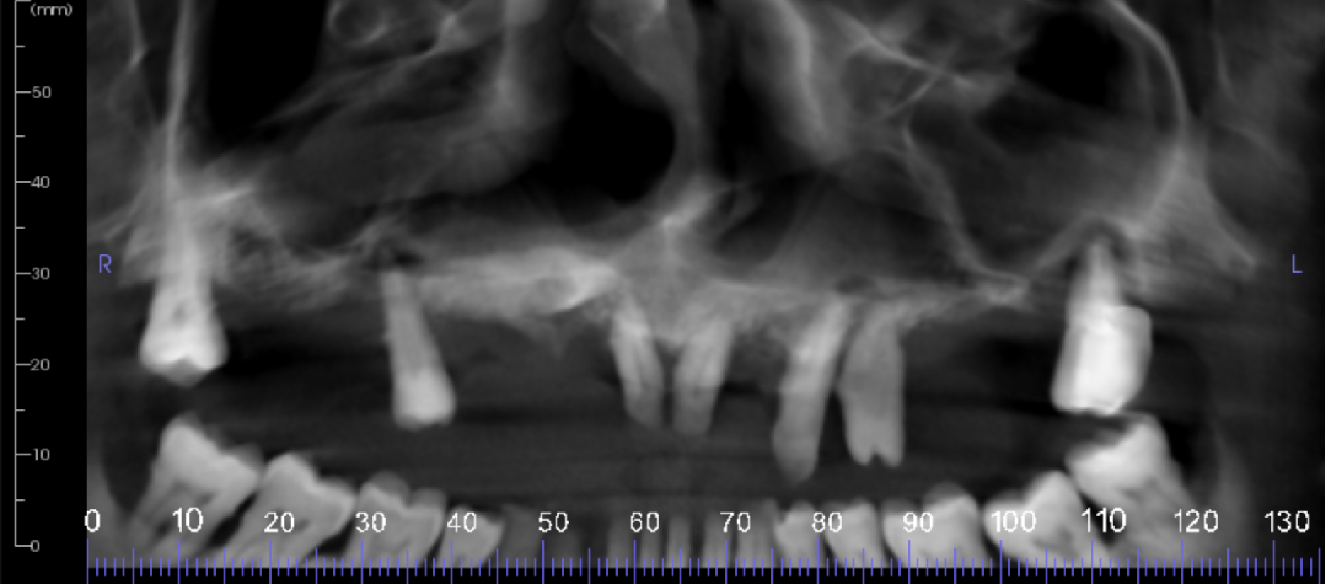CBCT reconstructed panoramic image