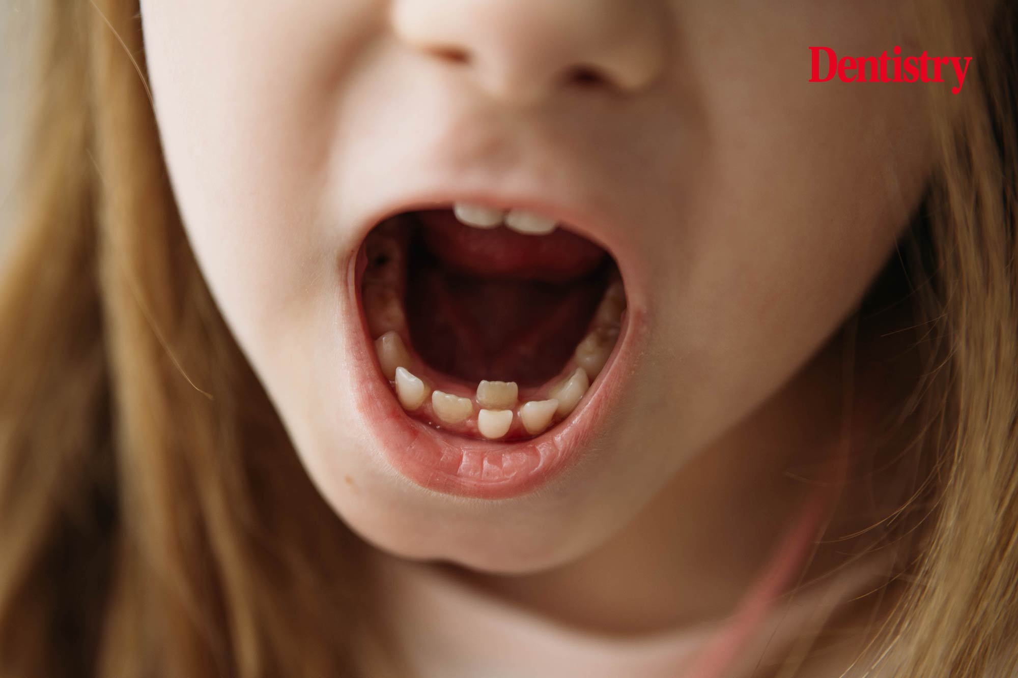 Growth lines in baby teeth track weight gain in adolescents