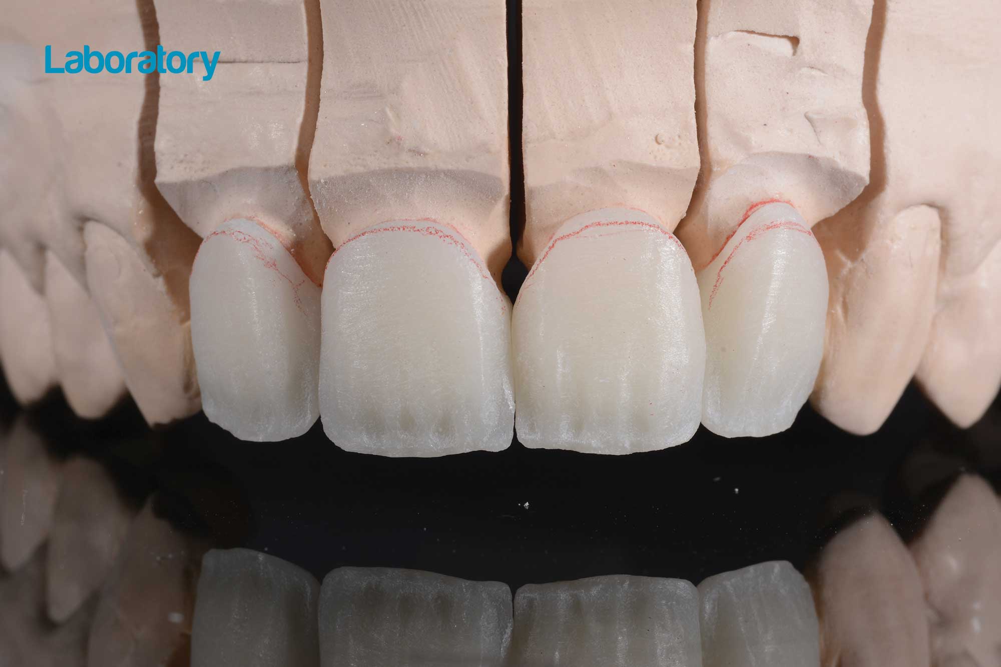 Incisal edge design on lithium disilicate crowns Dentistry