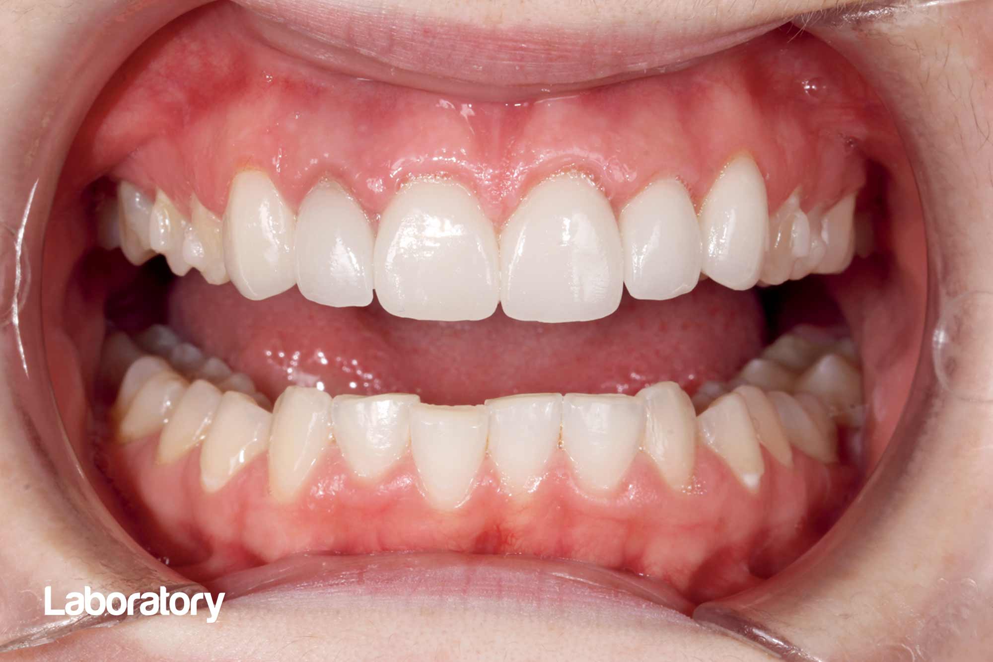 'The digital transformation is in full swing and is not for stragglers': Fabian Ebner presents a crown case using 3D printing, showing the benefits of using it in everyday dental work.