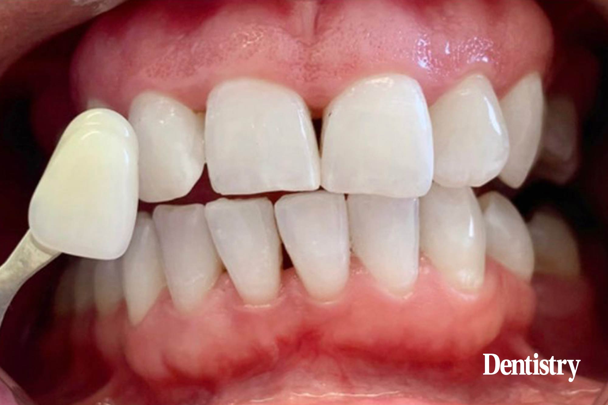 Melica Bastani, an award winning dental hygienist, presents an anxious and periodontally compromised tooth whitening case study for a patient ahead of her wedding. 
