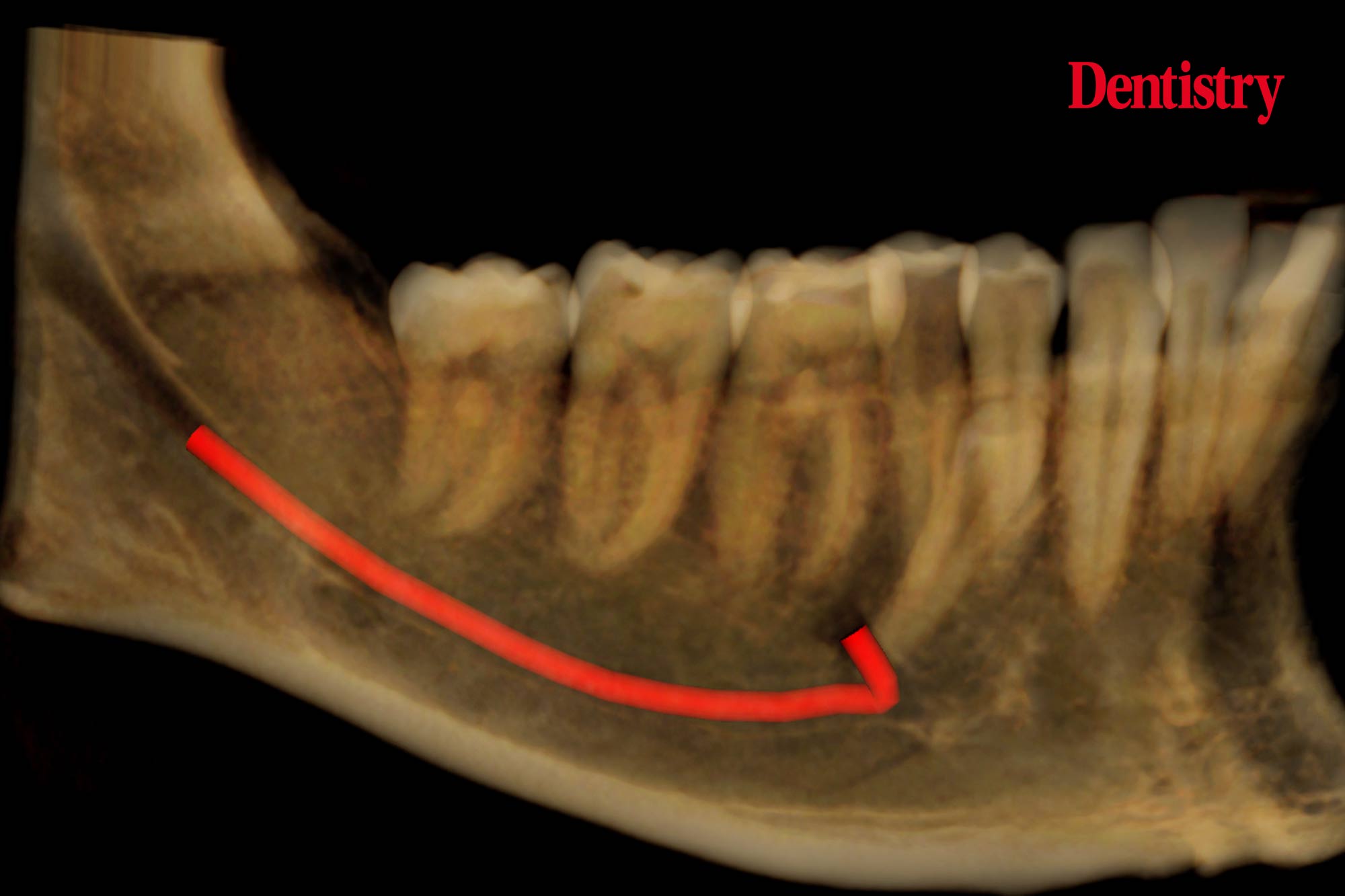 Case of the Week – unerupted supernumerary tooth in a mesioangular position