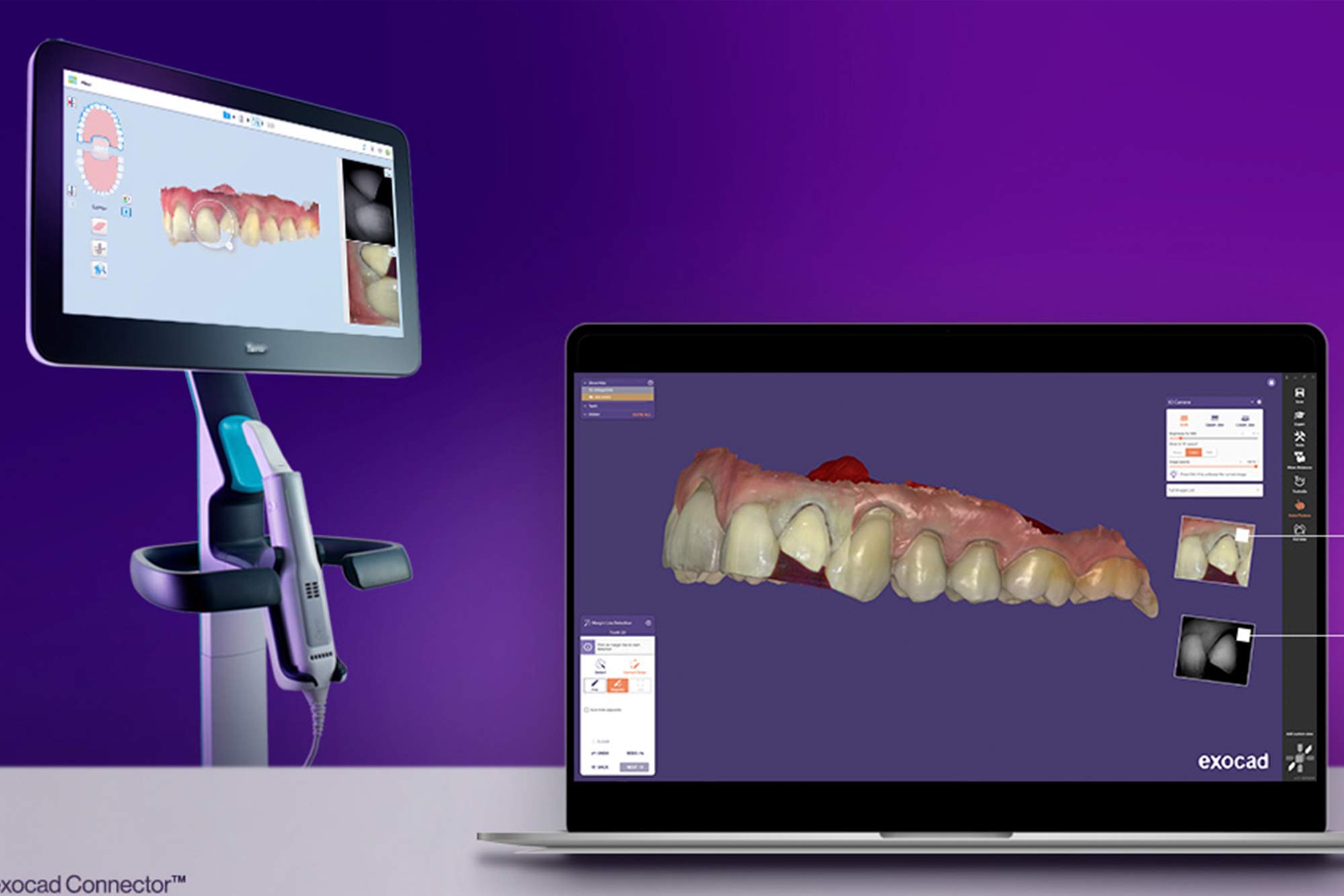 Align Tehcnology have announced a new Itero-Exocad connector software which enables advanced visualisation for doctors and labs, with seamless integration of Itero intraoral camera and NIRI images.